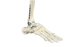 Ankle Fracture & ORIF 