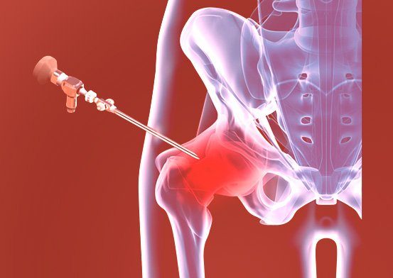 Treatment of Hip by Christopher J. Utz, M.D.