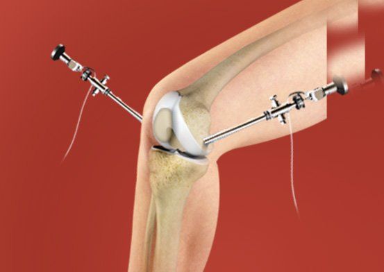 Treatment of Knee by Christopher J. Utz, M.D.