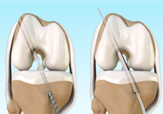 ACL Reconstruction