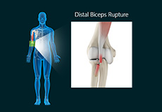 Distal Biceps Rupture & Distal Biceps Repair