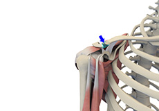 Distal Clavicle Excision