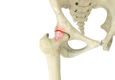 Femoroacetabular Impingement