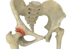 Hip Arthritis