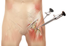 Hip Arthroscopy