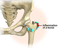 Hip Bursitis