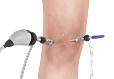 Knee Arthroscopy