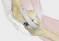 MCL Reconstruction