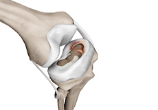 Meniscal Injuries