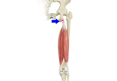 Proximal Hamstring Rupture & Surgical Repair