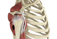 Arthroscopic Rotator Cuff Repair