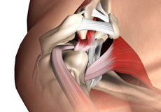 Subacromial Decompression